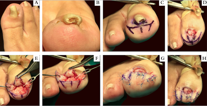 Correção cirúrgica de unha em pinça do hálux direito (a, b) pela técnica de Mutaf; c) Programação do retalho desenhando uma plastia em Z modificada em ambas as pregas ungueais laterais e porção distal do leito ungueal; d) Avulsão do prato ungueal; e) e f) As incisões são realizadas até o plano do periósteo e, posteriormente, transpõem-se os retalhos de leito ungueal, permitindo expor e excisar a exostose subungueal bem como alargar e aplainar leito ungueal distal; g, h) Sutura das incisões realizada com um fio monofilamentar não reabsorvível