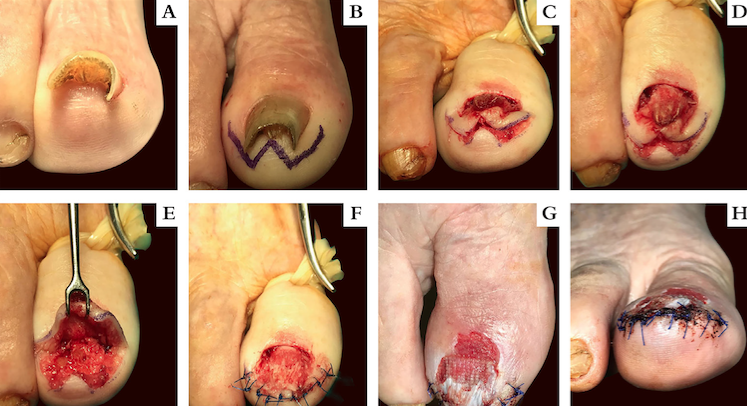 Correção cirúrgica de unha em pinça do hálux direito (a) pela técnica de Kosaka; b) Programação do retalho desenhando uma plastia em forma de W (ou zigue-zague); c, d) Após avulsão da placa ungueal, é realizada a incisão, em forma de W, 5mm abaixo do hiponíquio e prolongada paralelamente num plano supraperiósteo; e) O retalho de pele contendo o leito ungueal é elevado, expondo e aplainando a superfície dorsal da falange distal, estirado em direção transversal, e a pele excedente das porções laterais do retalho é removida; f) Sutura do retalho num padrão em zigue-zague, com um fio monofilamentar não reabsorvível; g, h) Resultado ao 15º dia pós-operatório, antes de retirar os pontos