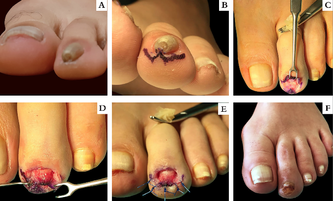 Utilização da técnica de Kosaka (em W ou zigue-zague), descrita na figura 2, na correção cirúrgica da unha em pinça do 2º pododáctilo esquerdo, igualmente com sucesso