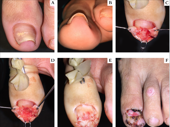 Correção cirúrgica da unha em pinça do hálux esquerdo (a, b) pela técnica de Fanti. Nesta técnica, além da avulsão da placa ungueal, realiza-se uma incisão em forma de U ao redor das pregas laterais e distal e, ainda, uma incisão longitudinal ao longo do eixo do leito ungueal desde a prega proximal até a distal; c, d) Descolamento do leito ungueal num plano supraperiósteo, e levantamento dos dois retalhos que expõem o leito ungueal e permitem a remoção do osteófito dorsal da falange distal; e) Sutura dos retalhos sobre o leito, agora aplainado; f) Resultado pós-operatório no 15º dia, momento da retirada dos pontos