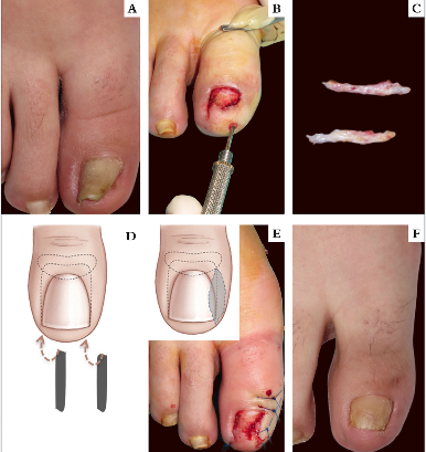 Correção cirúrgica de unha em pinça do hálux direito (a) pela técnica de Zook modificada; b) Após avulsão do prato ungueal, realizada tunelização subcutânea ao longo dos bordos laterais do leito ungueal e coleta de enxertos dérmicos colhidos com bisturi na prega inguinal ipsilateral (c); d) Realizada a implantação dos enxertos de derme colhidos nos túneis subcutâneos criados, o que permitiu o aplainamento do leito ungueal; e) Adicionalmente, na prega lateral externa, por hipercurvatura marcada, optou-se por associar uma excisão fusiforme sem envolver a matriz ungueal (técnica de Zook modificada); f) Resultado após um ano de seguimento