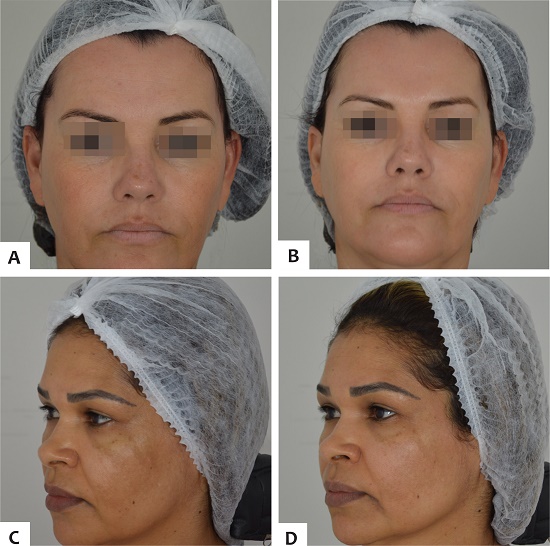 A e C - Fotos pr&eacute;vias B e
                            D - Fotos 90 dias ap&oacute;s peelings
                        quimicos superficiais e clareadores t&oacute;picos