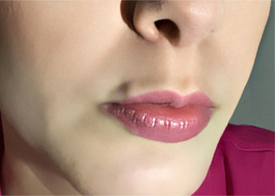 nódulo indolor no lábio superior