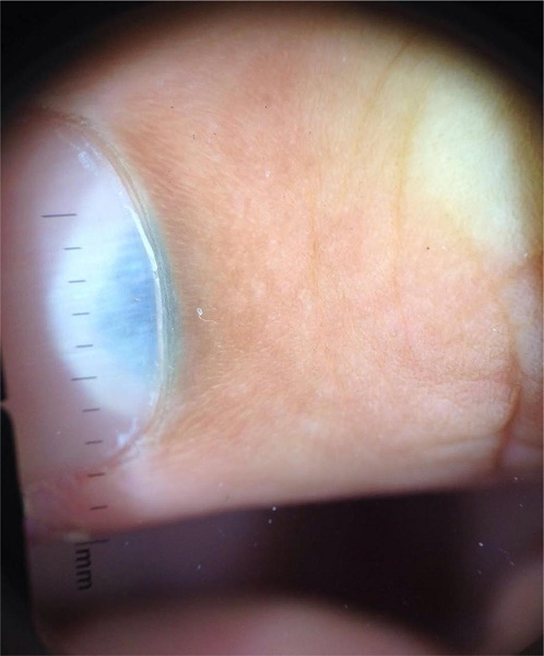 Dermatoscopia da lesão subungueal - mancha azulada semicircular na
                        lúnula