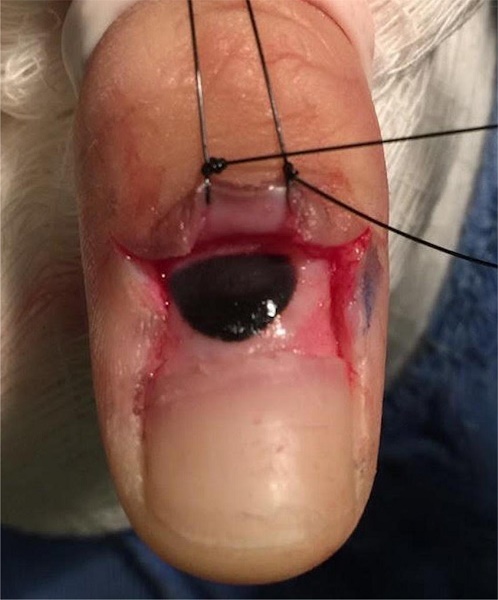 Lesão fortemente pigmentada observada após
                        mobilização da dobra ungueal proximal