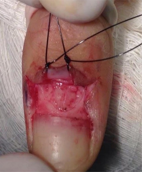 Realizada biópsia excisional da lesão por
                            shaving