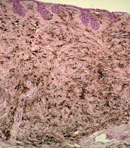 Histologia evidenciando proliferação de melanócitos
                        fusiformes e dendríticos hiperpigmentados, formando feixes em meio
                        às fibras colágenas