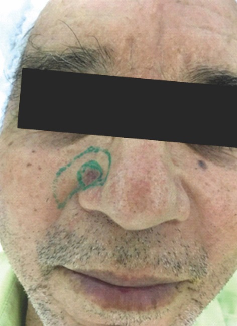 Demarcação da lesão e retalho em ilha de tubarão