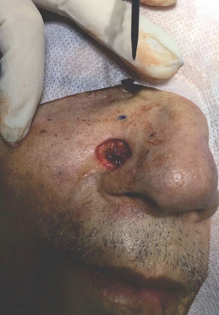 Defeito cirúrgico final