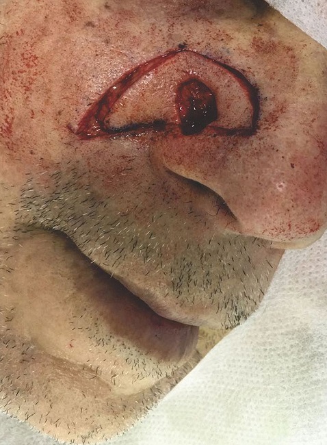 Preparo do braço inferior do retalho com descolamento do pedículo
							subcutâneo