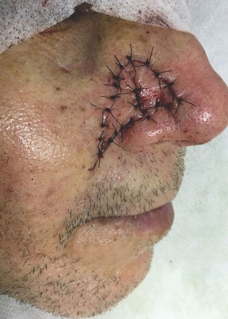 Cone de redundância após rotação de 90o do braço superior