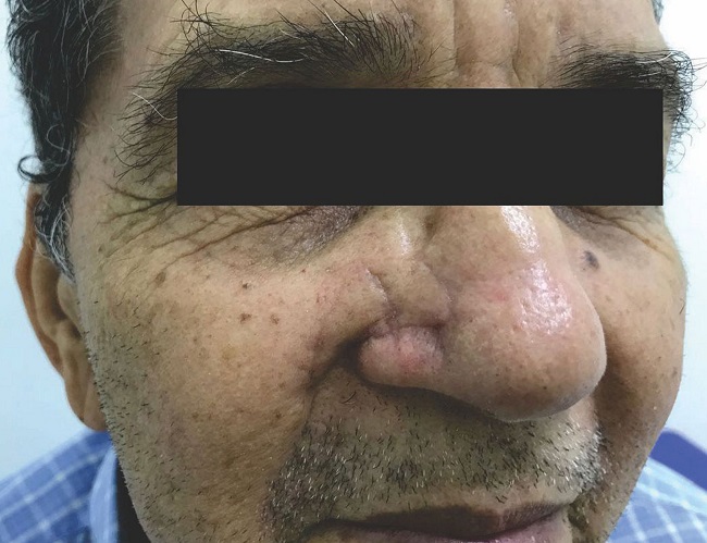 Sessenta dias de pós-operatório. Preservação do sulco nasal