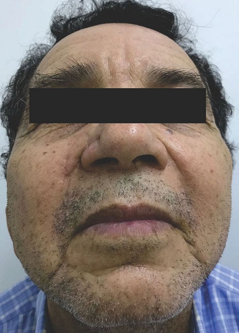 Sessenta dias de pós-operatório. Sem alteração da anatomia da asa e
							introito nasais