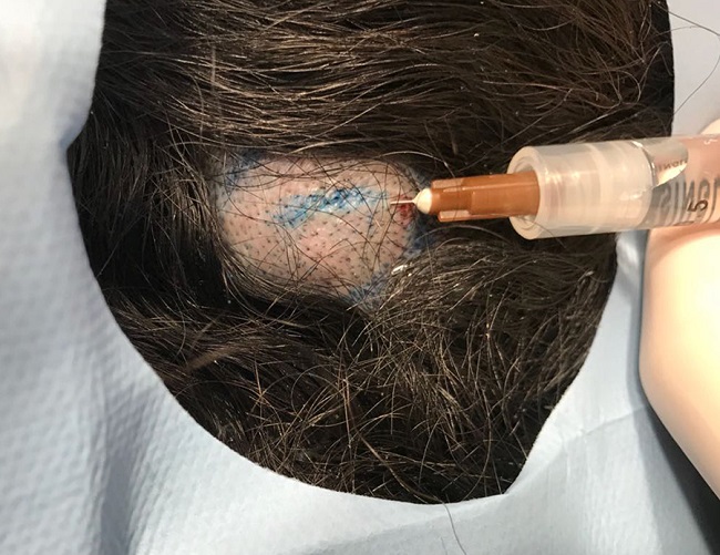 Anestesia com vasoconstritor local na incisão
										central