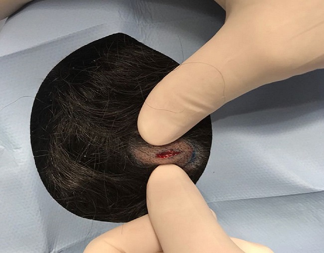Incisão central no cisto