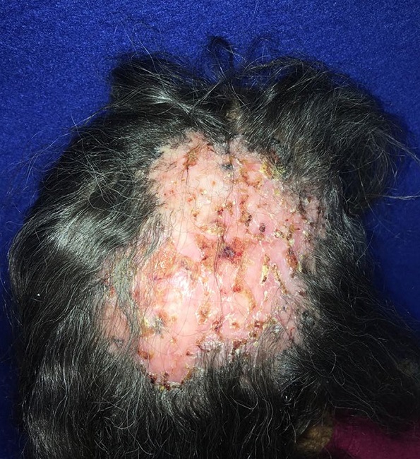 Paciente no momento do diagnóstico com extensa placa de alopecia
							cicatricial, periferia com bordas papulosas, pigmentadas