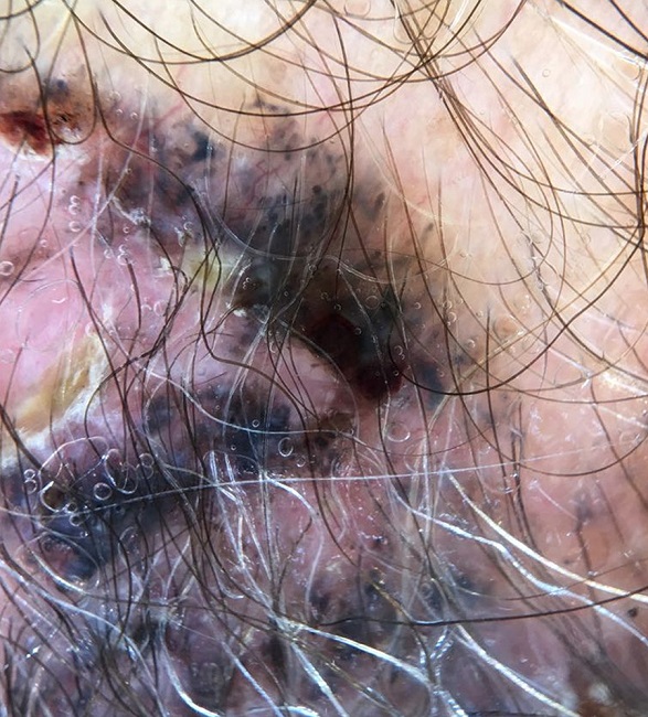 Dermatoscopia com presença de grandes glóbulos cinza-azulados
							desfocalizados, vasos tortuosos com ramificação arboriforme