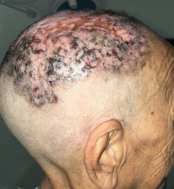 Paciente no pré-operatório com lesão medindo 17 x 17cm