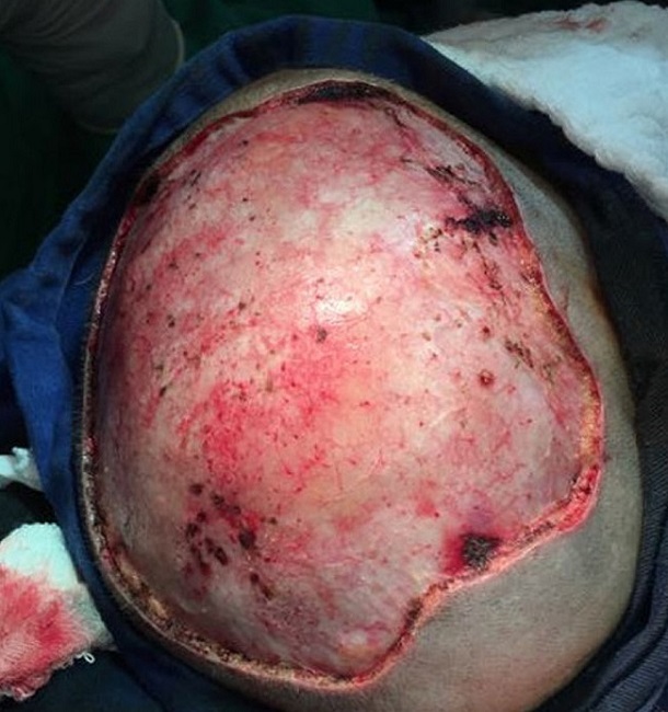 Paciente no pós-operatório imediato após exérese de lesão com
							fechamento por segunda intenção