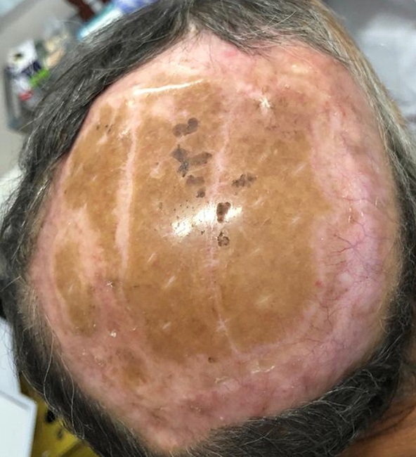 Paciente após três meses de enxerto de pele parcial em segundo tempo
							cirúrgico