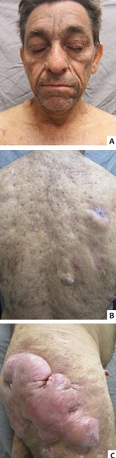 Paciente apresentando hipercromia reticulada facial
									(A), associada a m&uacute;ltiplos comed&otilde;es abertos e
								les&otilde;es c&iacute;sticas em dorso (B). Em regi&atilde;o lateral de
								gl&uacute;teo e quadril direito, h&aacute; presen&ccedil;a de grande massa tumoral
								endurecida associada a les&otilde;es fistulizadas com sa&iacute;da de secre&ccedil;&atilde;o
								purulenta (C)