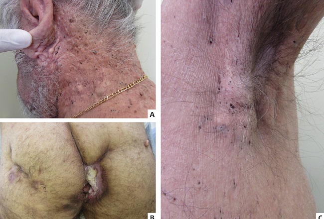 (A) Regi&atilde;o cervival m&uacute;lltiplos cistos e comed&otilde;es.
									(B) tumorac&atilde;o vegetante e ulcerada em regiao
								perianal e interglutea. (C) Regi&atilde;o axilar m&uacute;ltiplos
								cistos e comed&otilde;es.