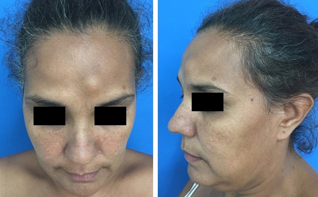 N&oacute;dulo m&oacute;vel, de cerca de 2cm na fronte &agrave; esquerda, sem acometimento
							da pele suprajacente