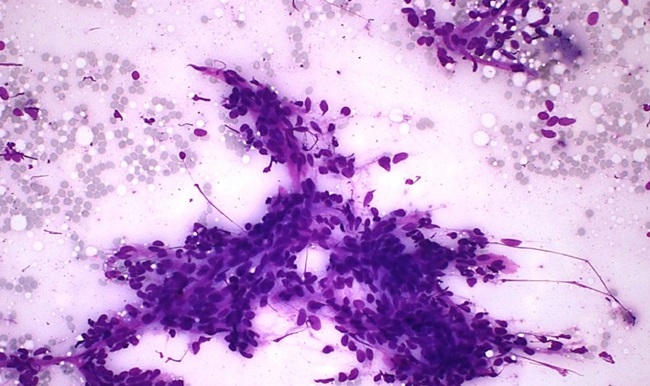 PAAF: presen&ccedil;a de aglomerado de c&eacute;lulas mesenquimais
							fusocelulares