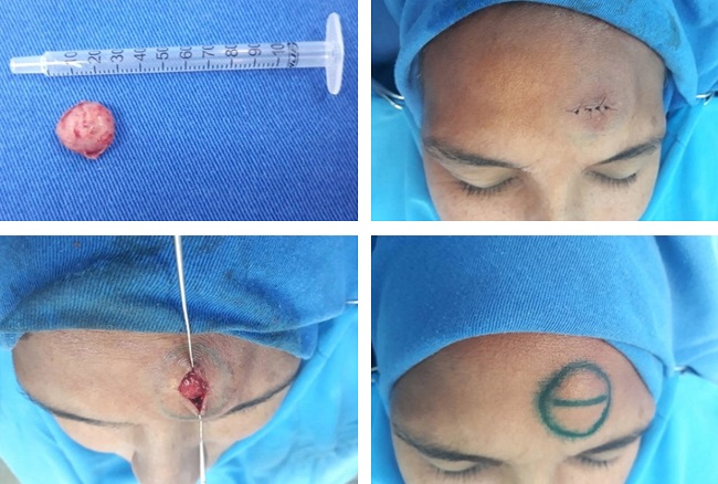 Ex&eacute;rese completa da les&atilde;o, com retirada de n&oacute;dulo de cor
							amarelo-clara, de cerca de 1,5cm e aspecto parenquimatoso &agrave;
							palpa&ccedil;&atilde;o