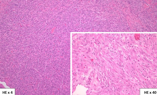 Histopatologia: presen&ccedil;a de prolifera&ccedil;&atilde;o mesenquimal com atipias
							discretas