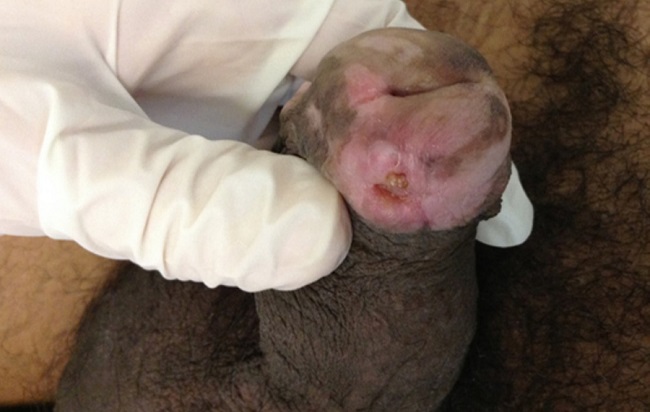 Placa erit&ecirc;mato-hipocr&ocirc;mica de limites imprecisos, com ulcera&ccedil;&atilde;o ao
							centro, em face ventral de glande, &agrave; esquerda