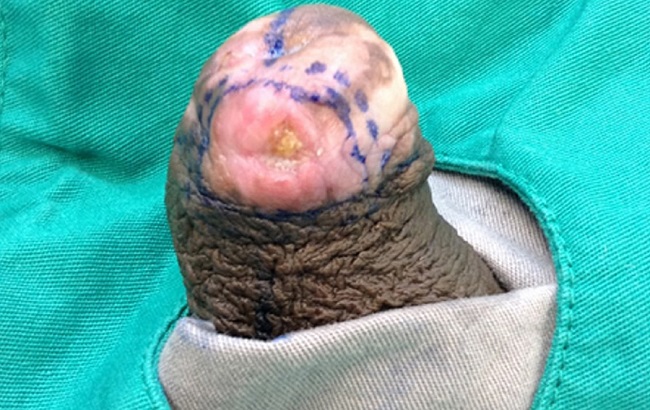 Imagem evidenciando a marca&ccedil;&atilde;o dos limites cl&iacute;nicos da les&atilde;o
							tumoral