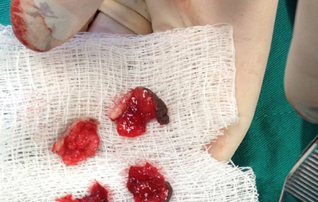 Primeiro est&aacute;gio da cirurgia microgr&aacute;fica de Mohs, evidenciando
							amplia&ccedil;&atilde;o de margens profundas e perif&eacute;ricas