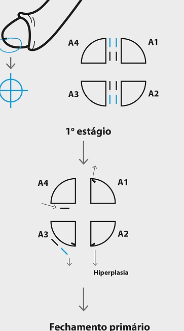 Mapa topogr&aacute;fico da cirurgia microgr&aacute;fica de Mohs