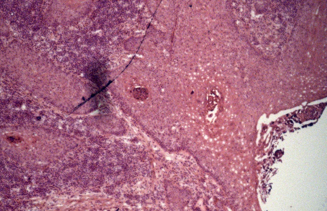 Foto de l&acirc;mina por corte e congela&ccedil;&atilde;o: prolifera&ccedil;&atilde;o de c&eacute;lulas
							escamosas at&iacute;picas, com forma&ccedil;&atilde;o de linguetas que se projetam e
							infiltram a derme, coexistindo hiperceratose, disceratose e atividade
							inflamat&oacute;ria cr&ocirc;nica liquenoide