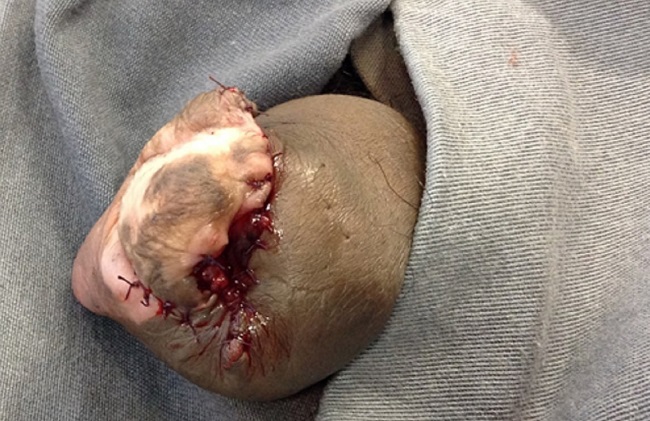 Fechamento prim&aacute;rio de defeito cir&uacute;rgico