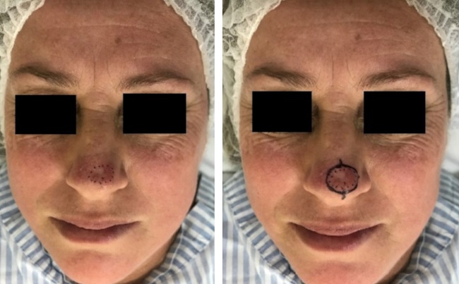 CBC na ponta nasal e marca&ccedil;&atilde;o pr&eacute;-operat&oacute;ria dos limites