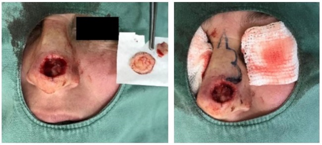 Ex&eacute;rese por meio de cirurgia microgr&aacute;fica de Mohs e marca&ccedil;&atilde;o de
							retalho trilobado com azul de metileno