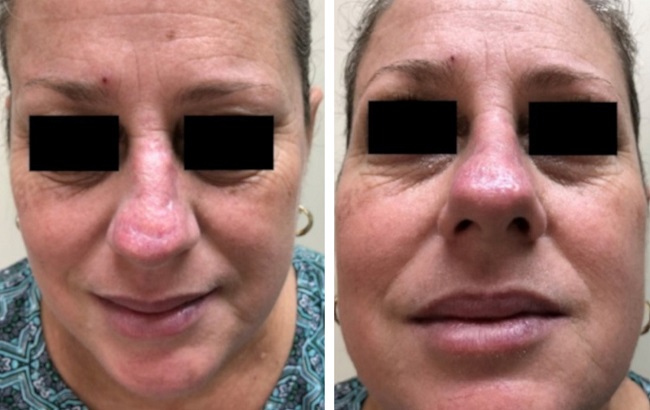 P&oacute;s-operat&oacute;rio tardio: 60 dias