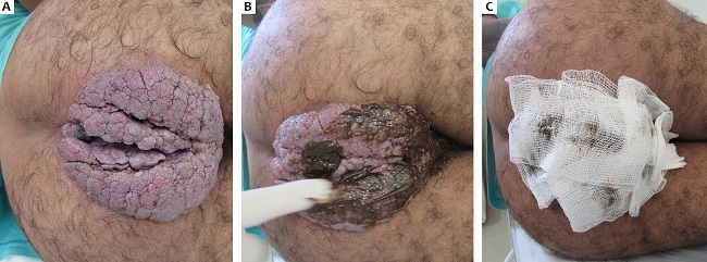 Tumor de Buschke-Lowenstein, caso 01. (A) Aspecto
							cl&iacute;nico da les&atilde;o. (B) Aplica&ccedil;&atilde;o da podofilina 25% em
							vaselina s&oacute;lida na les&atilde;o e (C) prote&ccedil;&atilde;o com gaze antes do
							paciente colocar sua roupa