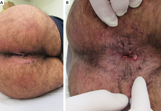 Tumor de Buschke-Lowenstein, caso 01. (A) Aspecto
							cl&iacute;nico ap&oacute;s 23 sess&otilde;es semanais realizadas durante seis meses.
								(B) Detalhe da regi&atilde;o perianal com afastamento dos
							gl&uacute;teos