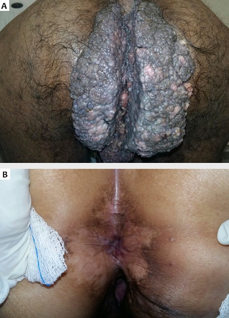 Tumor de Buschke-Lowenstein, caso 02. (A) Aspecto
							cl&iacute;nico da les&atilde;o pr&eacute;-tratamento e (B) ap&oacute;s 12 sess&otilde;es
							semanais realizadas durante quatro meses