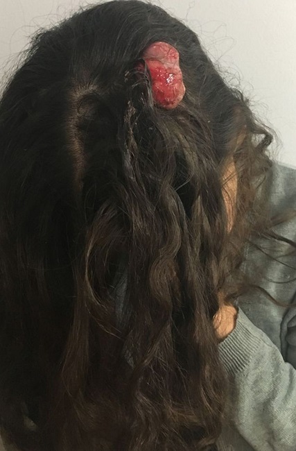 Tumor exofítico, ulcerado, com exsudação sanguinolenta, na região
							parietal esquerda de uma jovem, medindo 10 x 5cm
