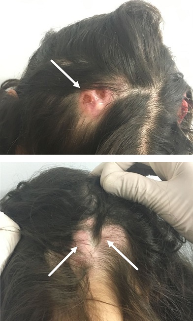 Tumores macios, lisos, alguns ulcerados, de 1 a 3cm, circundados por
							área de alopecia em couro cabeludo