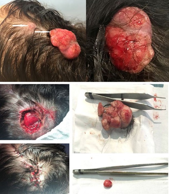 Exérese ampla de dois tumores triquilemais proliferantes no couro
							cabeludo