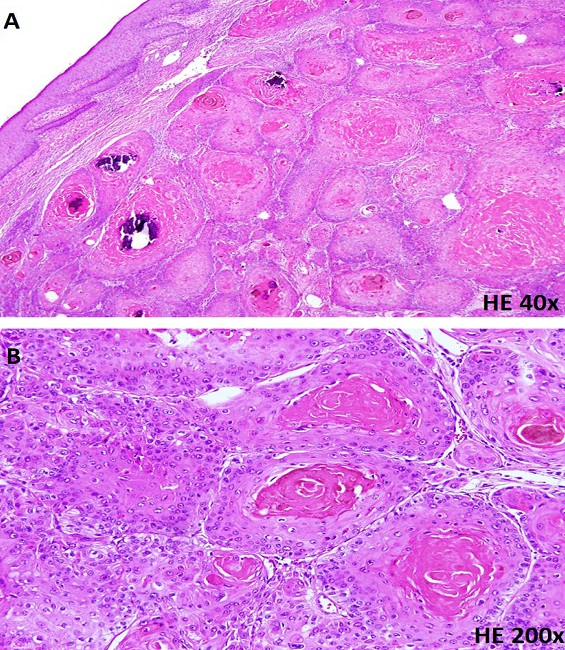 (A) Tumor dérmico com múltiplos lóbulos de tamanhos variados,
							proliferação de células escamosas com queratinização abrupta e focos de
							calcificação. (B) Lóbulos epiteliais escamosos com atipias discretas,
							associadas à massa de queratina amorfa, e ausência de infiltrado
							inflamatório