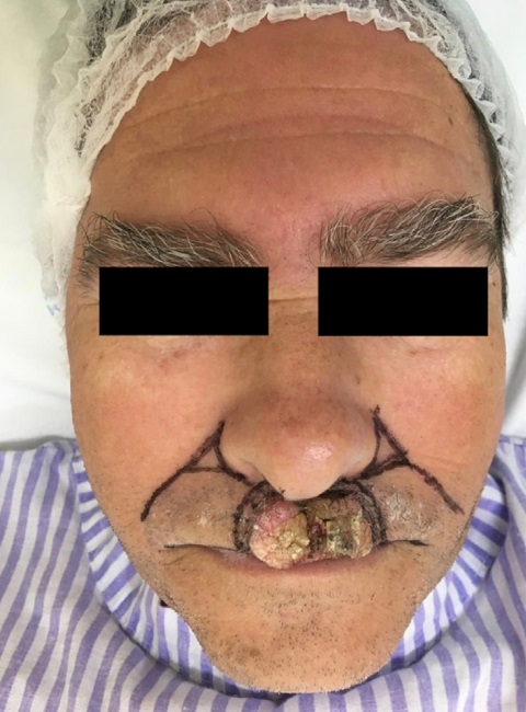 les&atilde;o vegetante-verrucosa e demarca&ccedil;&atilde;o dos retalhos de
							avan&ccedil;os