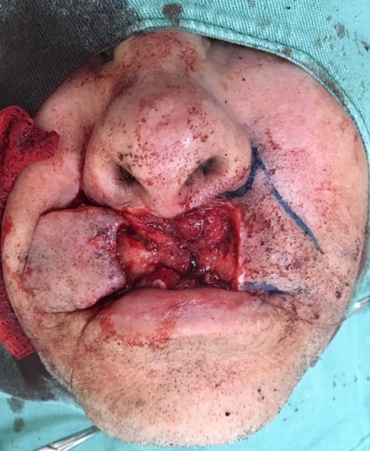 Excis&atilde;o da les&atilde;o