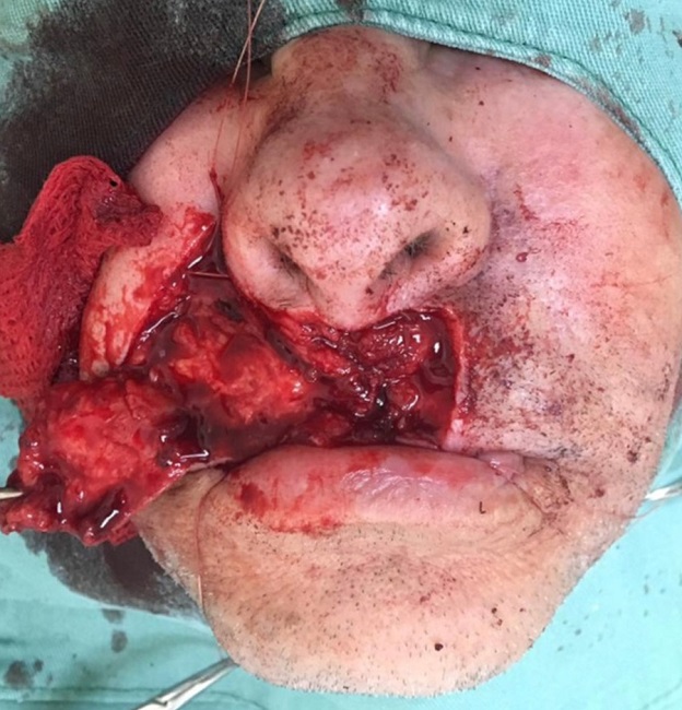 Retalho de Avan&ccedil;o descolado