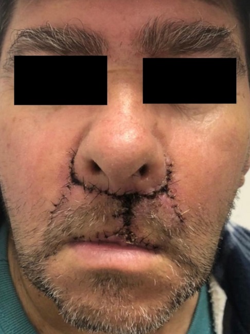 sete dias de p&oacute;s-operat&oacute;rio